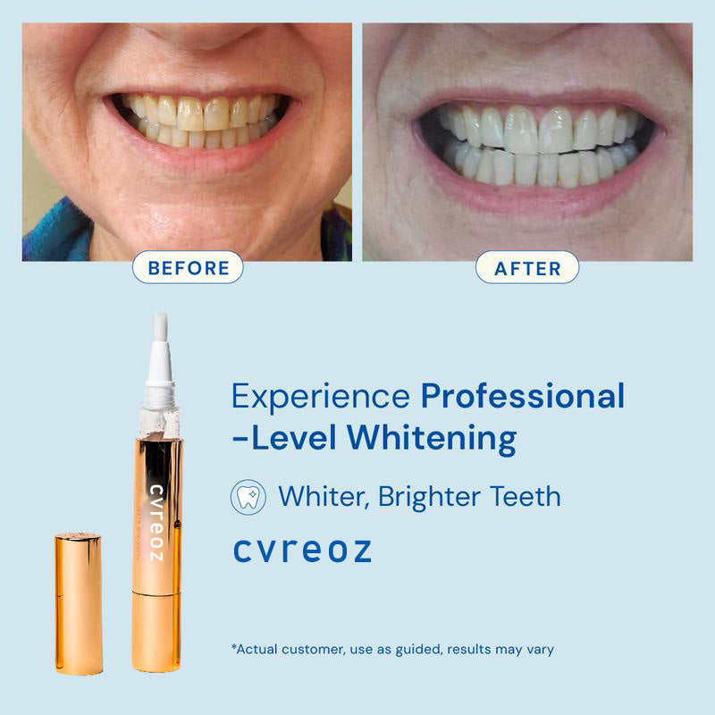 Clinically Proven Teeth Whitening Essence – No Sensitivity, Just Shine🦷✨