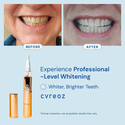 Clinically Proven Teeth Whitening Essence – No Sensitivity, Just Shine🦷✨